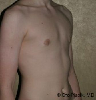 Male Breast Reduction - Before & After - Dr. Placik