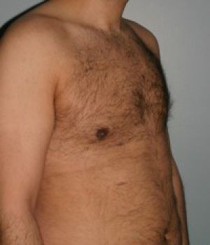 Male Breast Reduction - Before & After - Dr. Placik