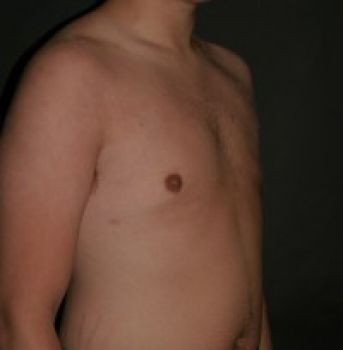 Male Breast Reduction - Before & After - Dr. Placik