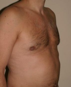 Male Breast Reduction - Before & After - Dr. Placik