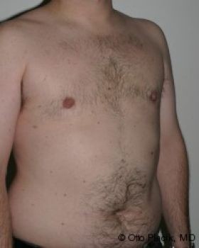 Male Breast Reduction