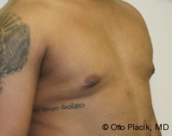 Male Breast Reduction - Before & After - Dr. Placik