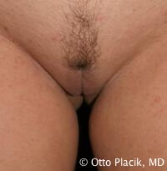 Labiaplasty with and without Clitoral Hood Reduction - Before & After - Dr. Placik