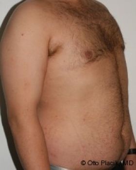 Male Breast Reduction - Before & After - Dr. Placik