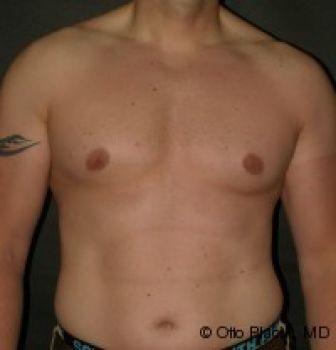 Male Breast Reduction Chicago