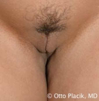 Labiaplasty Chicago