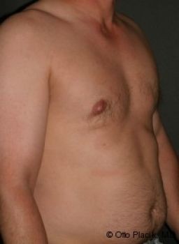 Male Breast Reduction Chicago