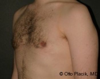 Male Breast Reduction