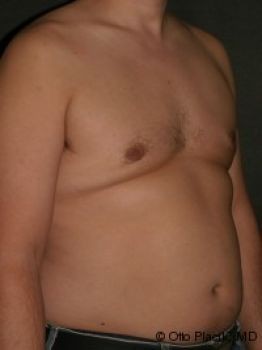 Male Breast Reduction Chicago