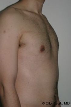 Male Breast Reduction