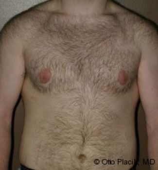 Male Breast Reduction Chicago