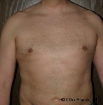 Male Breast Reduction Chicago