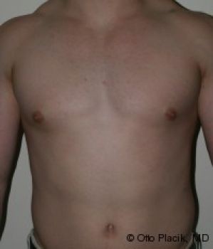 Male Breast Reduction