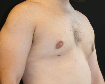 Male Breast Reduction Chicago