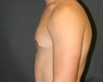 Male Breast Reduction Chicago