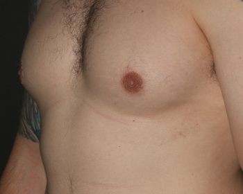 Male Breast Reduction Chicago