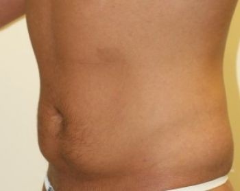 Male Liposuction in Chicago