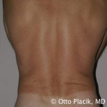 Male Liposuction Chicago