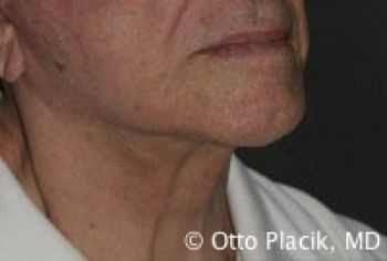 Male Neck Lift