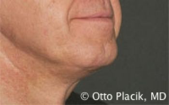 Male Neck Lift