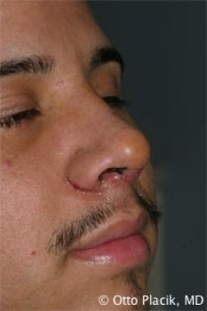 Male Rhinoplasty in Chicago