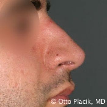 Male Rhinoplasty - Before & After - Dr. Placik