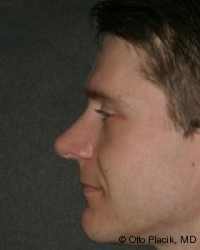 Male Rhinoplasty