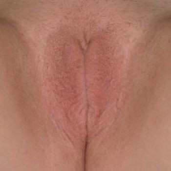 Labiaplasty