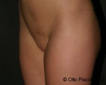 Mons Pubis Reduction Utilizing Liposuction