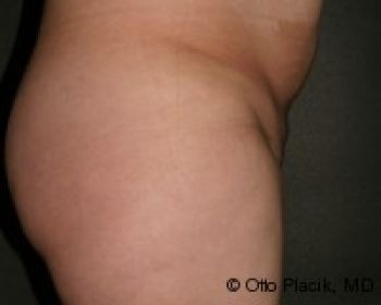 Mons Pubis Reduction Utilizing Liposuction