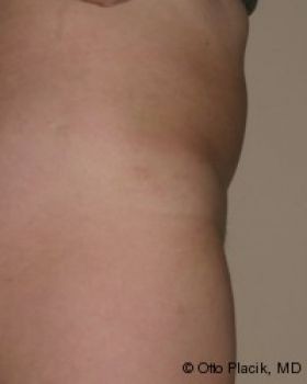 Mons Pubis Reduction - Before & After - Dr. Placik