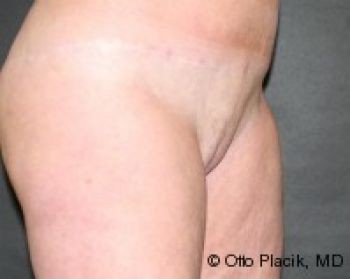 Mons Pubis Reduction - Before & After - Dr. Placik