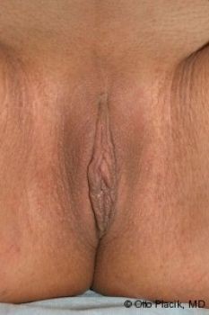 Labiaplasty with Clitoral Hood Reduction