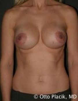 Breast Revision Chicago