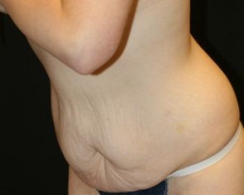 Tummy Tuck - Before & After - Dr. Placik