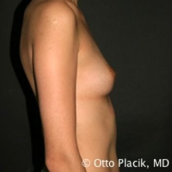 Breast Augmentation