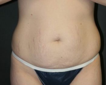 Tummy Tuck - Before & After - Dr. Placik