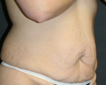 Tummy Tuck Chicago