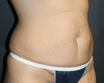 Tummy Tuck Chicago