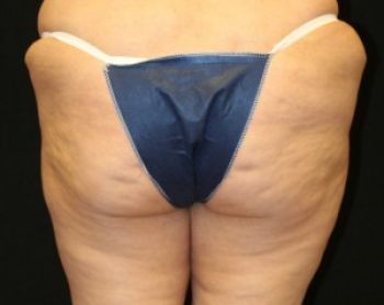 Liposuction Chicago