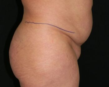 Butt Augmentation - Before & After - Dr. Placik