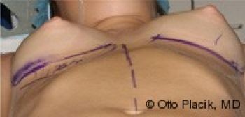 Breast Augmentation