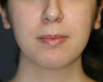 Buccal Fat Extraction - Before & After - Dr. Placik