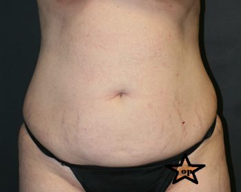 Tummy Tuck - Before & After - Dr. Placik