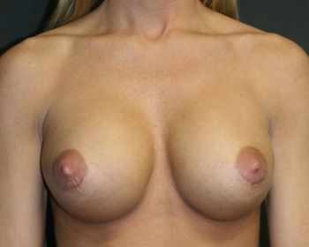 Breast Implant Exchange - Before & After - Dr. Placik