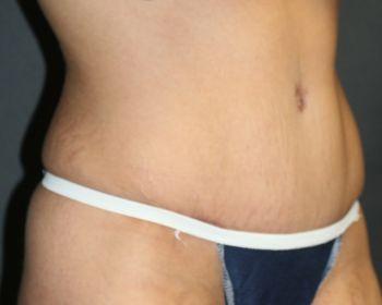 Tummy Tuck Chicago