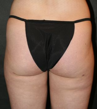 Liposuction - Before & After - Dr. Placik