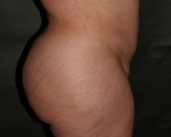 Butt Augmentation - Before & After - Dr. Placik