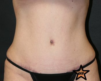 Tummy Tuck - Before & After - Dr. Placik