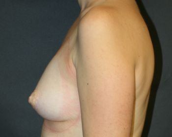 Breast Augmentation with Fat Grafting Chicago